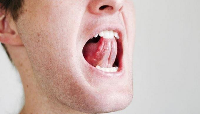 Några enkla övningar för halsen och tungan kan lindra situationen snarkning. / Foto: i2.wp.com. 