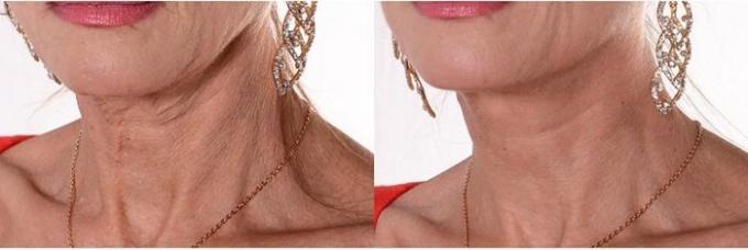 Beauty-konstigt: varför kvinnor lim tejp på halsen
